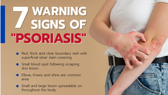 there-are-seven-signs-that-you-have-psoriasis-phitsanulok-hospital